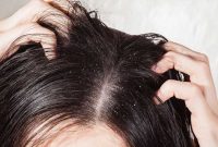 4 Treatment for Dandruff Hair that You Can Do Yourself