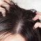 4 Treatment for Dandruff Hair that You Can Do Yourself